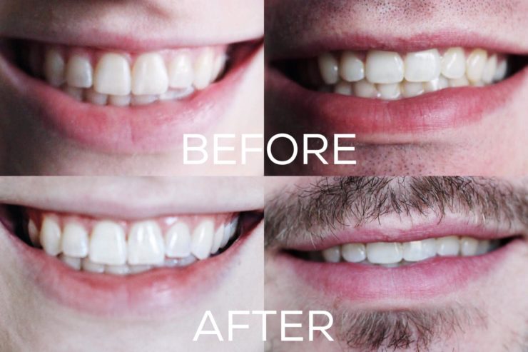Smile Brilliant before and after
